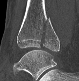 Ankle Fracture Large Posterior Malleolus CT